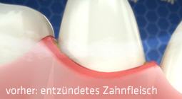 Die Emmi-dent Ultraschallzahnbürsten beseitigen Bakterien und Plaque, die die Ursache für die Entzündungen sind. Zahnstein wird wirksam vorgebeugt.